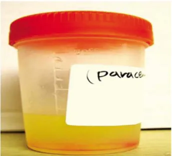 Fig. 5. Diagnostic paracentesis demonstrated that the ascitic fluid  was straw colored.