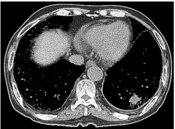 Fig. 3. Decreasing size of the LLL mass lesion (13 mm).