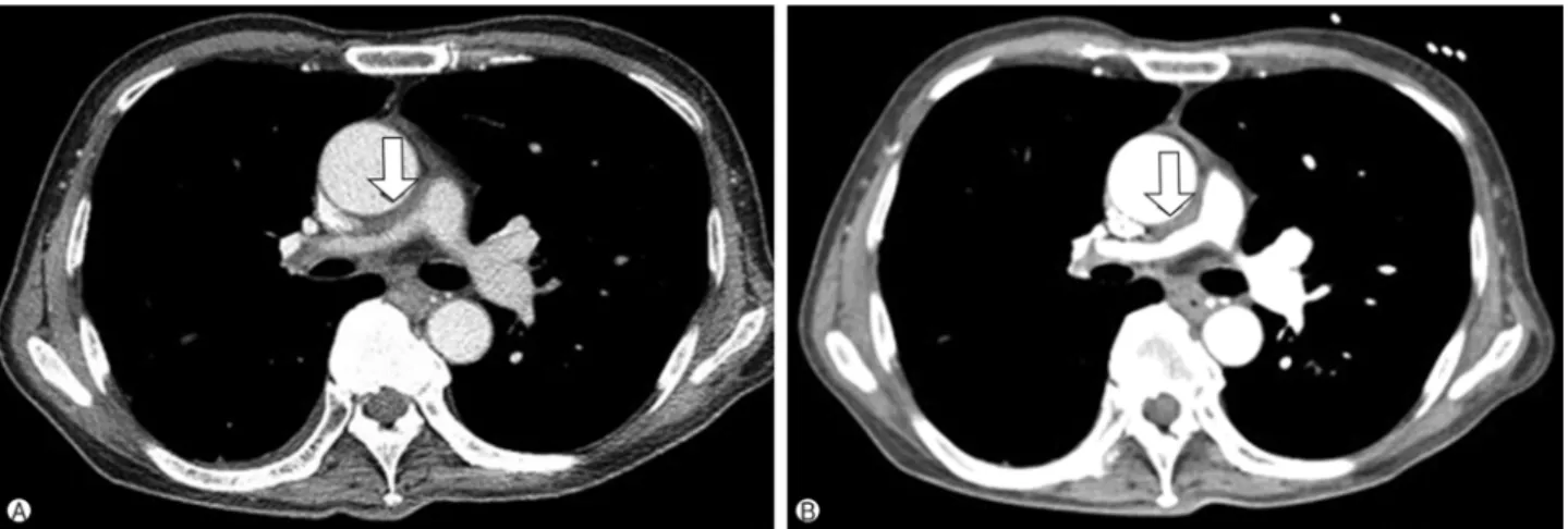 Fig. 1. Chest computed tomography showing (A) wall thickening and stenosis in the main pulmonary artery and in both proximal pulmonary arteries (right&gt;left) and (B) no interval change after 4 months (arrow).