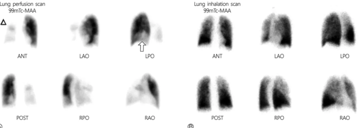 Fig. 2. (A) Lung perfusion scan showing severe perfusion defects in the right upper lobe (apical and posterior segments), and in the  right middle lobe (medial and lateral segments), as well as a large perfusion decrement in the right upper lobe anterior s