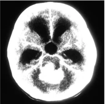 Fig. 1. The computerized tomography showed a 4×4 cm-sized tumor in the posterior cranial fossa with calcification and strong enhancement.