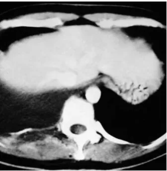 Fig. 2. Computed tomographic scan showing pleural effusion, large low-attenuated, irregular-shaped mass lesions with  periph-eral rim enhancement.