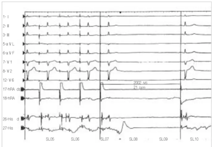 Fig. 1. Surface 12-lead ECG recorded at rest in the patient. Fig. 2. Sinus node recovery time during electrophysiologic study (paper speed: 50 mm/sec)