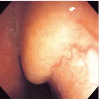 Fig. 1. Endoscopic view of the large longitudinal round mass with normal overlying mucosa in mid and distal esophagus