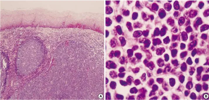Fig. 4. (A) Histologic section disclosed proliferation of lymphoid cells in a large follicular pattern with occasional germinal center formation (H&amp;E, ×40)