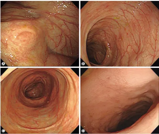 Fig. 5. Third colonoscopy finding (on 63rd day) shows almost complete mucosal healing after  ganciclovir therapy (A, cecum; B, transverse colon; C, sigmoid colon; D, rectum).