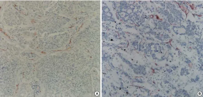 Fig. 3. Immunostaining for CD34. (A) Squamous cell carcinoma shows increased CD34-positive microvessels in the interfaces between carcinoma nests and stoma (×100)