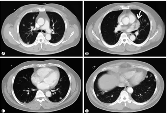 Fig. 1. 3-cm sized mass (arrow) in the left upper lobe of the lung and multiple small nodular  shadows in both lungs were shown at preoperative chest computed tomography (April 10, 2012).