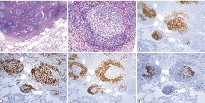 Fig. 2. (A) Reactive follicles with no involvement of lymphoid cells in adjacent bronchial epithelium (H&amp;E stain, ×40)