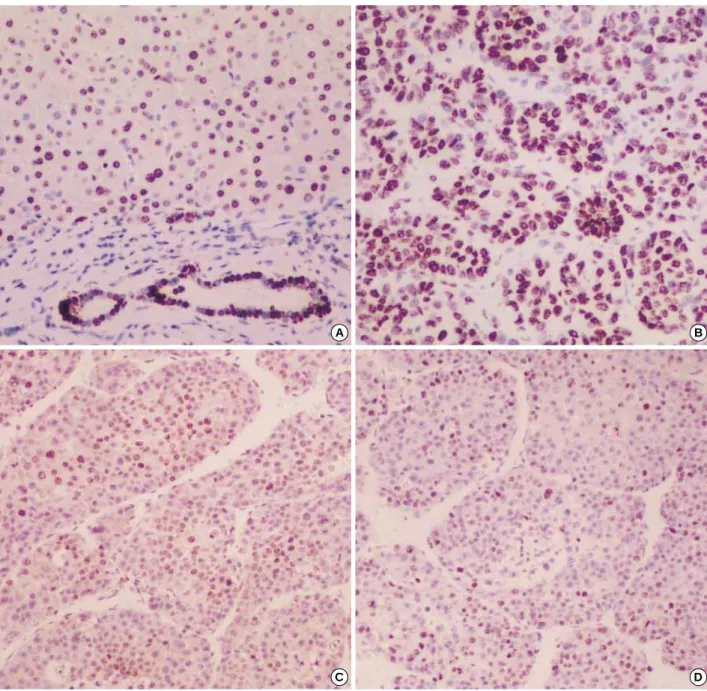 Fig. 2. Expression of Cyclin D1 protein (A, B, and C) and Ki-67 immunostaining (D). (A) Nonneoplastic hepatocytes showing scattered cyclin D1-positive nuclei
