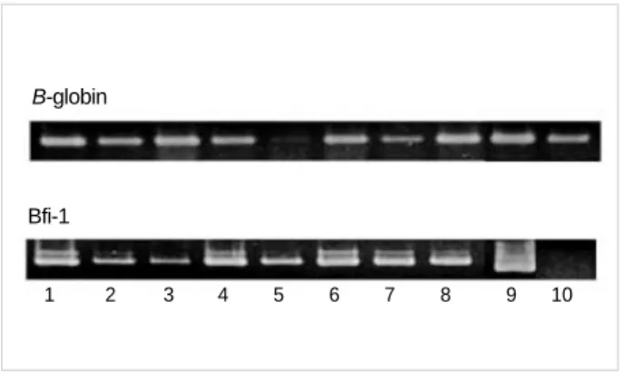Fig. 1. RT-PCR analysis of Bfl-1 mRNA in breast cancer tissues.