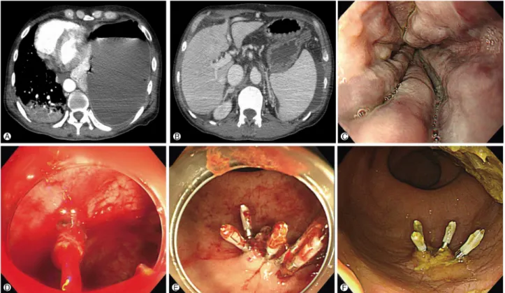 Fig. 1. (A, B) Computed tomography showed a large lung empyema displacing the heart and cirrhotic liver with ascites