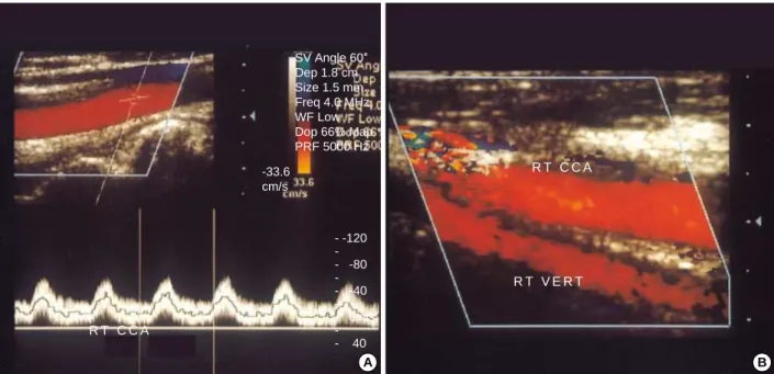 Fig. 4. Postoperative carotid duplex scan shows (A) a normal arterial waveform and a markedly increased volume flow of the right com- com-mon carotid artery (RT CCA) and (B) a to-and-fro waveform of the ipsilateral vertebral artery (RT VERT).