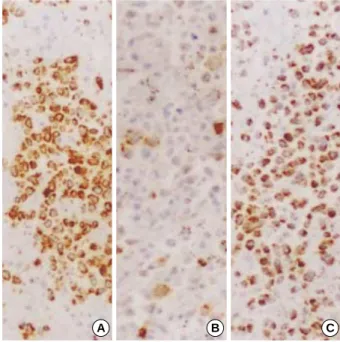 Fig. 3. The splenic red pulp is diffusely infiltrated with an abnormal population of lymphoid cells showing irregular large nuclei (A) (H&amp;E,  × 200)