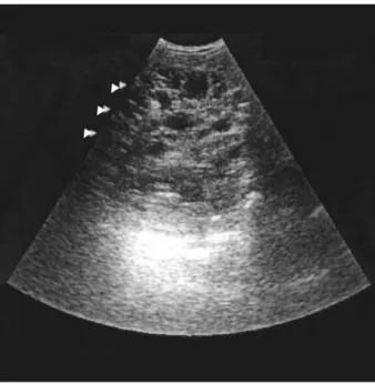Fig. 2. Abdominal US shows the enlarged right kidney filled with innumerable, variable-sized cysts and the absence of the left kidney.