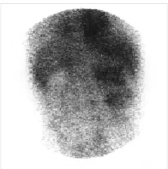 Fig. 4. 99mTc-DMSA demonstrates no radioactivity of the left kidney.