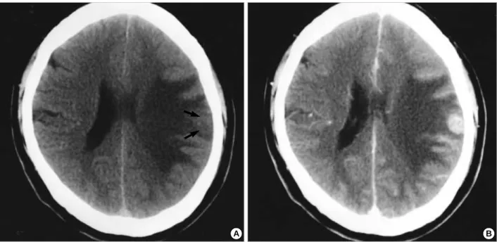 Fig. 1. (A) Pre-contrast computed tomography (CT) showing an ill-defined isodense mass (arrows), with severe surrounding edema in the left parietal cortex
