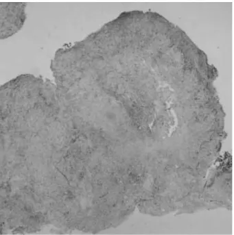 Fig. 4. High power photomicrograph of the tumor shows epithe- epithe-lioid to spindle shaped cells dispersed in a myxochondroid matrix (H&amp;E, ×400).