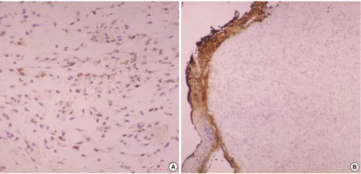 Fig. 6. On immunohistochemical studies, the myxoid chondrosarcoma shows a weak positive staining for S100 (A, ×200) and a lack of staining for GFAP (B, ×40).