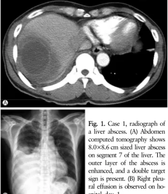 Fig. 1. Case 1, radiograph of  a liver abscess. (A) Abdomen  computed tomography shows  8.0×8.6 cm sized liver abscess on segment 7 of the liver