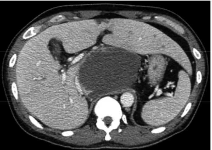 Fig. 2. Case 2, Abdomen computed tomography (CT) of a liver  abscess. Abdomen CT shows an 8.5×7.3 cm sized round single liver abscess on the caudate lobe.