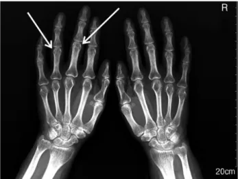 Fig. 1. X-ray of the hands. Radiograph of both hands shows soft  tissue swelling and periarticular bony erosions in the 3rd and 4th proximal interphalangeal joints.