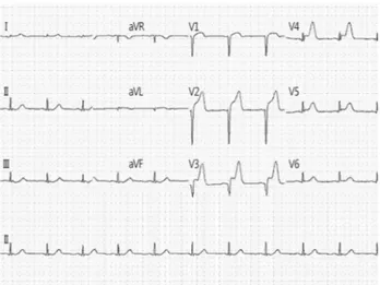 Fig. 1. Electrocardiogram in the emergency room showed defi-  nite ST segment elevation and Q wave in the anterior leads (V 2-5 ) and ST segment depression in leads III, aVF.