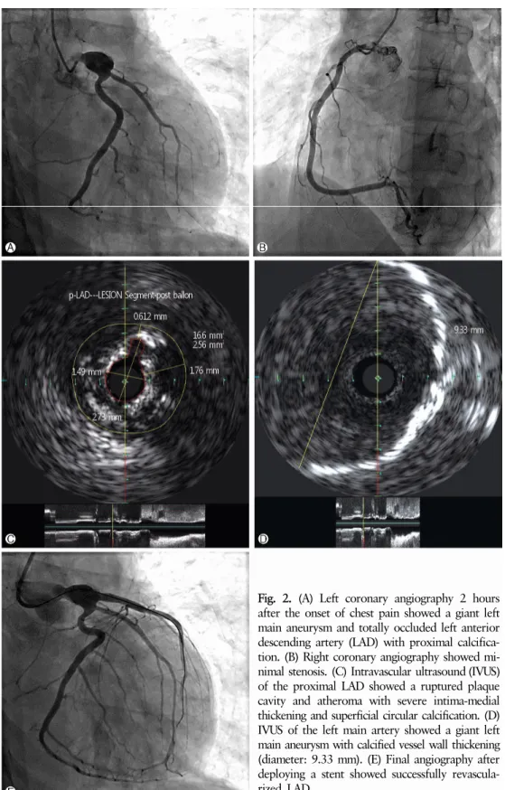 Fig. 2. (A) Left coronary angiography 2 hours  after the onset of chest pain showed a giant left  main aneurysm and totally occluded left anterior  descending artery (LAD) with proximal calcifica-  tion