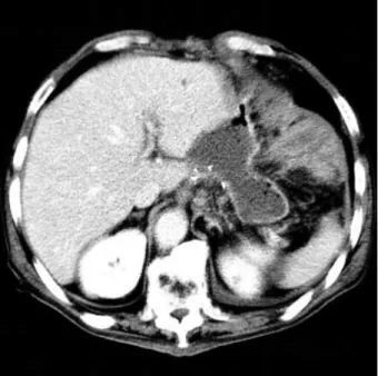 Fig. 1. Initial abdomen-pelvis computed tomography demon- demon-strates about 8 4 cm sized fluid collection in the  esophago-jejunostomy site.