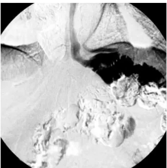 Fig. 4. Follow-up contrast study demonstrates that the stent has been passed out spontaneously without leakage of the contrast.