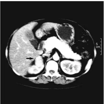 Fig. 1. Abdominal CT showing a right adrenal mass (arrow).