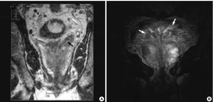 Fig. 1. Multiple irregular foci of low signal intensity are observed in the prostate as well as in the area of both seminal vesicles and vasa deferentia (arrow) on the T2-weighted MR imaging, suggesting tumor extension of prostatic carcinoma to the seminal