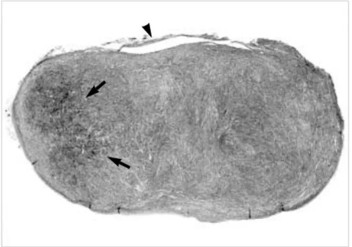 Fig. 1. A well-circumscribed oval mass is contiguous to the tunica dartos (arrowhead)