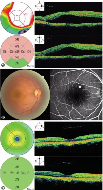 Fig. 1. The patient’s optical coherence tomography (OCT). (A)  OCT of the right eye showed a serous sensory retinal detachment and edema