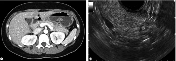 Fig. 1. (A) Computed tomography shows no abnormal lesion in the pancreas and abdomen. (B) Endoscopic ultrasonography shows no abnormal lesion and tumor in the pancreas.