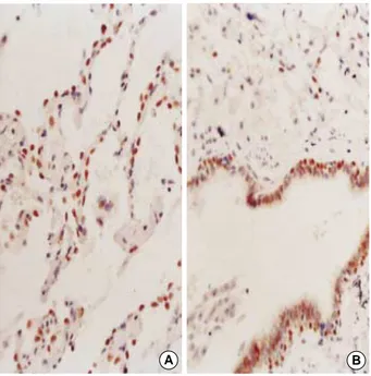 Fig. 4. Pulmonary small cell carcinoma showing high nuclear ex- ex-pression for thyroid transcription factor-1 (TTF-1) (×400).