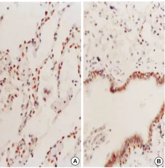 Fig. 4. Pulmonary small cell carcinoma showing high nuclear ex- ex-pression for thyroid transcription factor-1 (TTF-1) (×400).