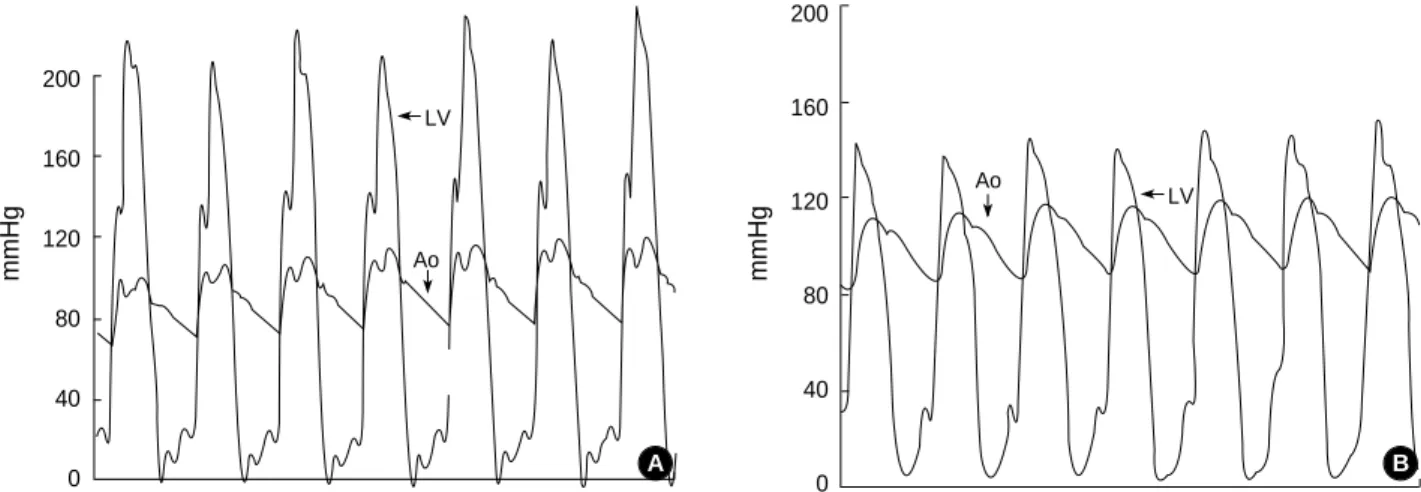 Fig. 3. Simultaneous aortic and left ventricular outflow tract pressure tracings before (A) and after (B) alcohol ablation.