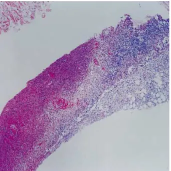 Fig. 1. Bone marrow aspirate shows histiocytes engulfing erythro- erythro-cytes (Wright stain, ×1,000).