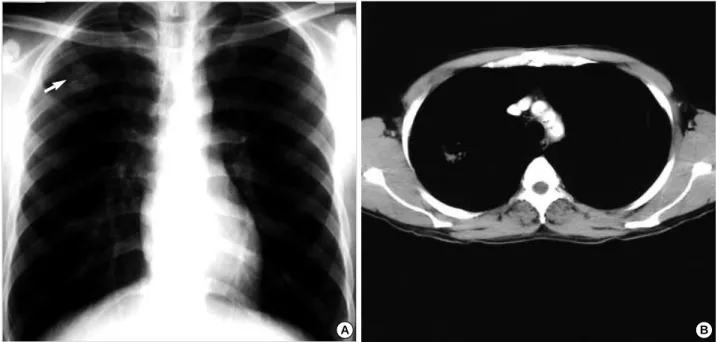 Fig. 1. On first admission, simple chest radiography shows about 2 cm sized, well-defined cavitary mass with thickened wall in the right upper lobe (A)