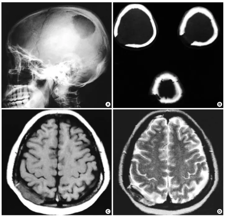 Fig. 1. (A-D) Radiologic findings. (A) Plain skull lateral film shows a round lytic defect, measuring 5 cm in diameter in the right parietal bone.