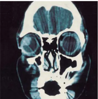 Fig. 3. The tumor is covered by the ciliary epithelium and mixed with normal ciliary smooth muscle (H&amp;E stain, ×40).