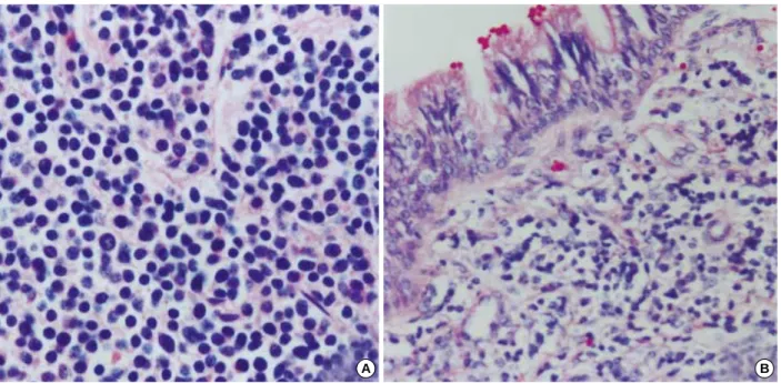 Fig. 1. In the adrenal, the tumor mass, adherent to the left kidney, is relatively well circumscribed and shows a variegated appearance with hemorrhage and necrosis (A)