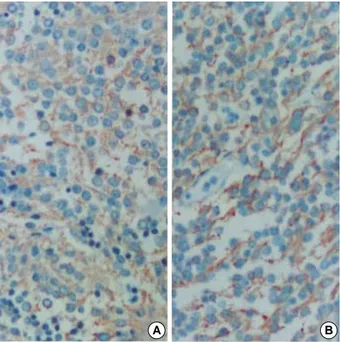 Fig. 3. Immunohistochemical stains against neuron specific eno- eno-lase (A) and chromogranin (B) show diffuse strong positivity in the tumor cells (×200).