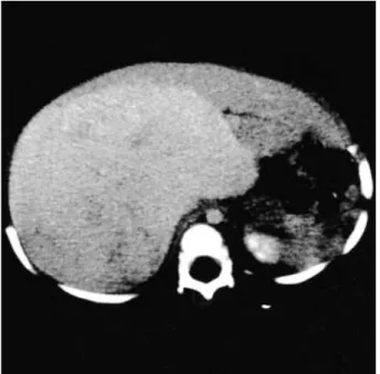 Fig. 2. Gross appearance. Note the solid cut surface with thin fibrous bands without macroscopic scar.