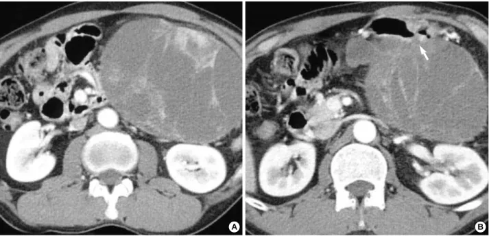 Fig. 1. Initial abdominal CT scan shows a 15×10 cm sized oval shaped low dense mass in peritoneal cavity with central thickened septa like enhancing solid component (A), which shows broad abutment with stomach in part (B, arrow).