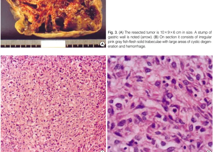 Fig. 3. (A) The resected tumor is 10×9×6 cm in size. A stump of gastric wall is noted (arrow)