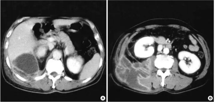 Fig. 1. Contrast-enhanced computed tomography images (A, B) show a 10-cm sized multi-septated cystic lesion with rim-like enhance- enhance-ment involving the right back muscles extending into the retroperitoneum.