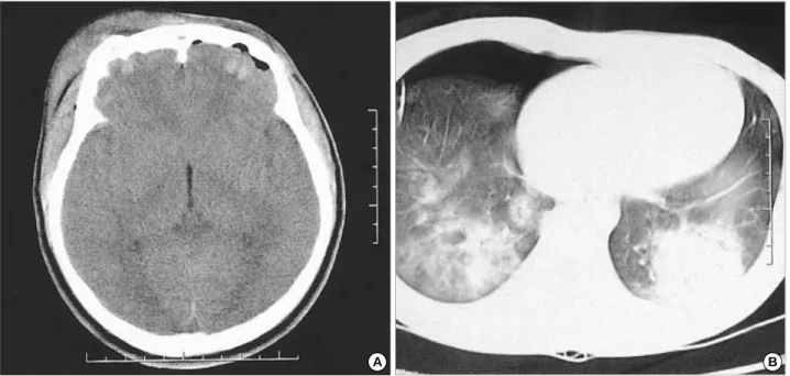 Fig. 4. An echocardiogram reveals anteroseptal akinesia and severe left ventricular dysfunction with ejection fraction of 28%.