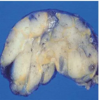 Fig. 1. CT scan shows a relatively well-demarcated lobulated solid mass in the anterior mediastinum.